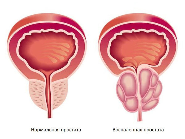 Tratamente si remedii naturale pentru prostata